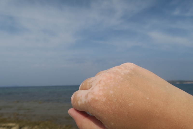 Vitiligo by Teta Gabi